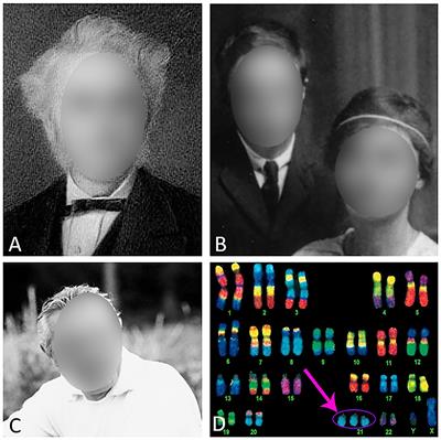 Editorial: Down Syndrome, Neurodegeneration and Dementia